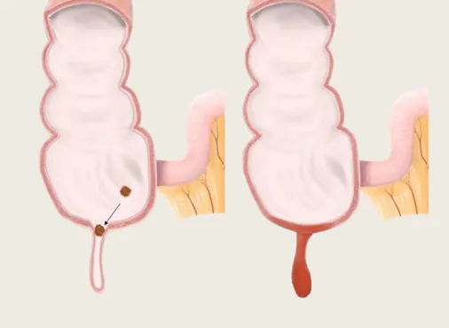 Acute Appendicitis consultation at Niraaya Hospital